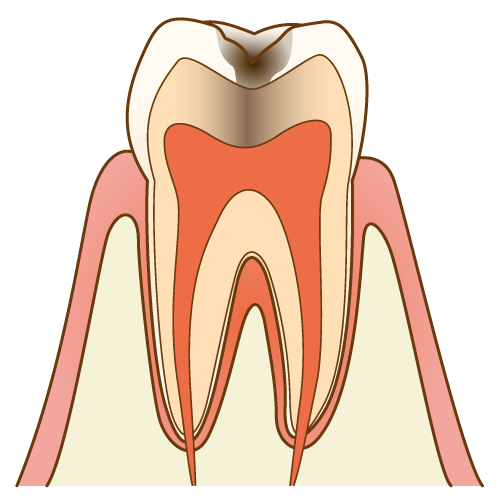 中度の虫歯