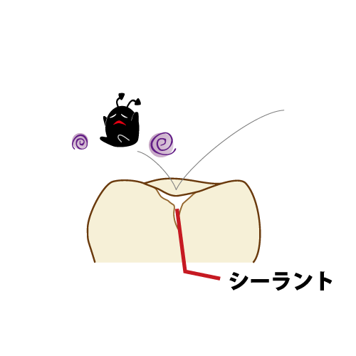 シーラントが虫歯菌を寄せ付けません