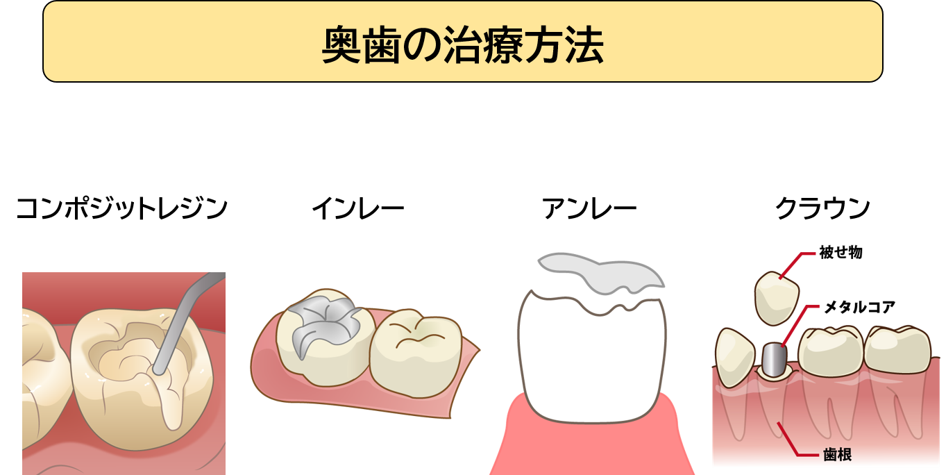 奥歯の治療方法