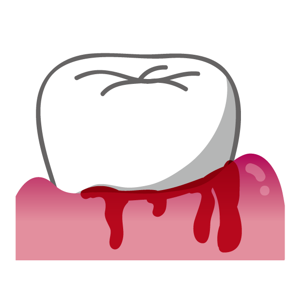 歯磨きすると歯茎から出血！これは歯周病？