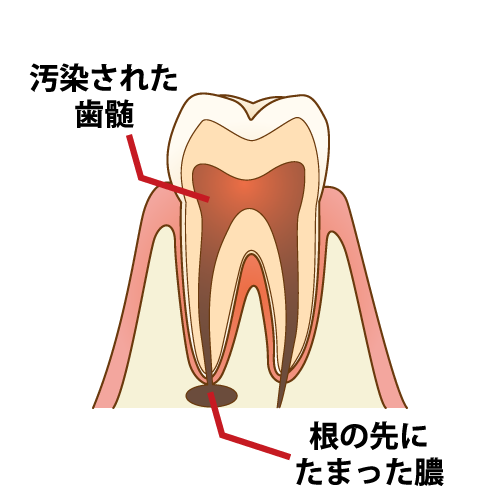 歯の神経を残す根管治療（歯内療法）