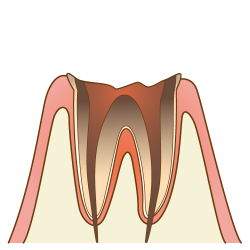 末期の虫歯