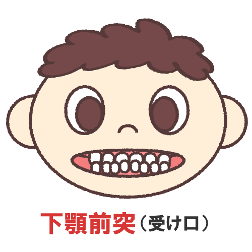 矯正歯科　受け口
