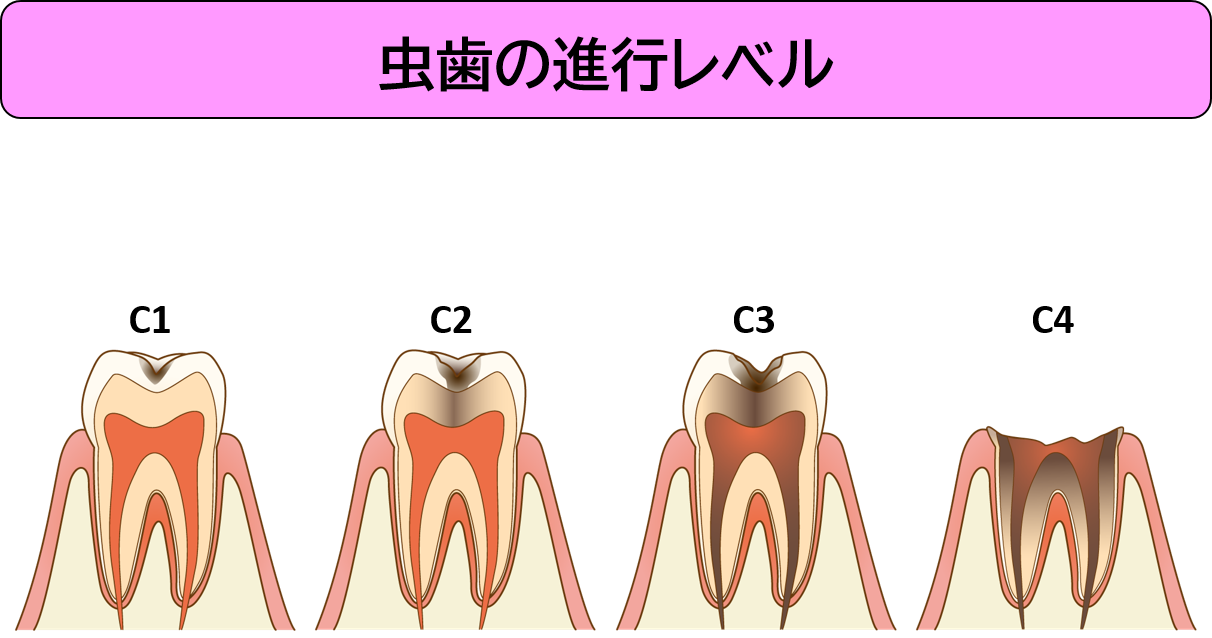 虫歯の進行レベル