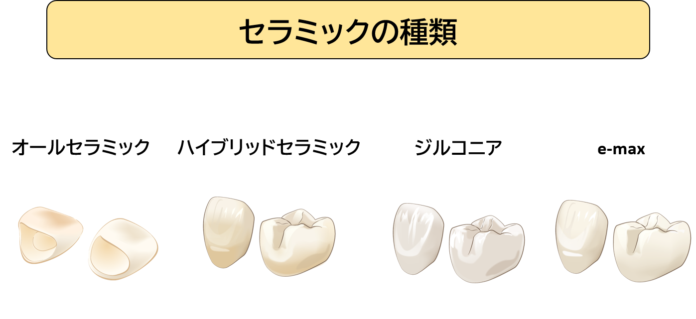 セラミックの種類