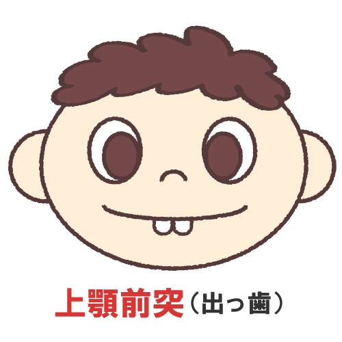 矯正歯科　出っ歯