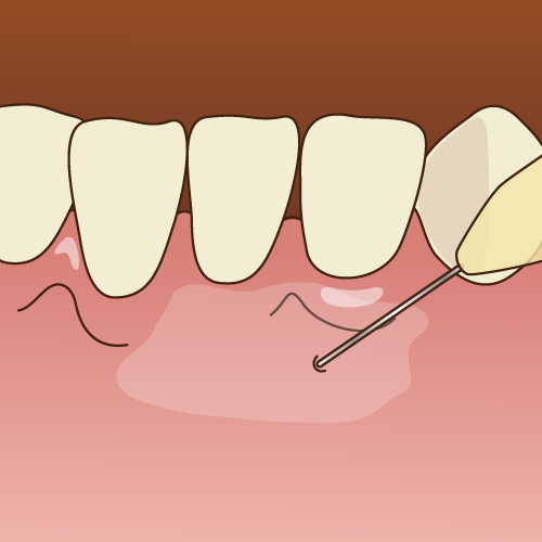 虫歯治療の際の注射