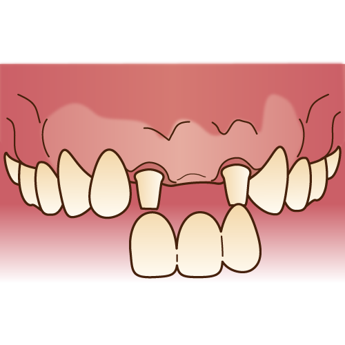 ブリッジ治療