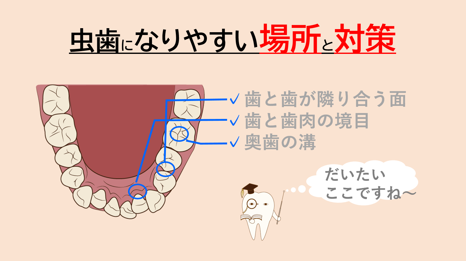 虫歯になりやすい場所があるって知っていましたか？