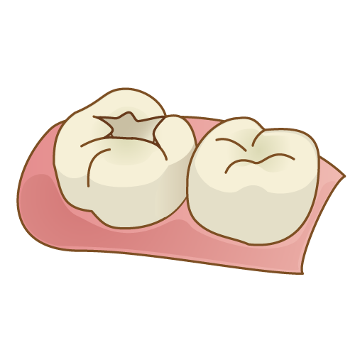 歯が黒い（虫歯）