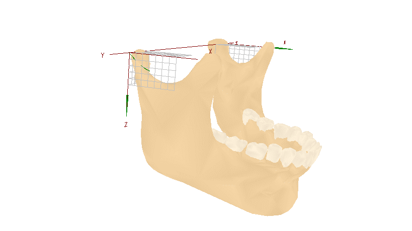 適切な咬合ができるアゴの位置を診断した図