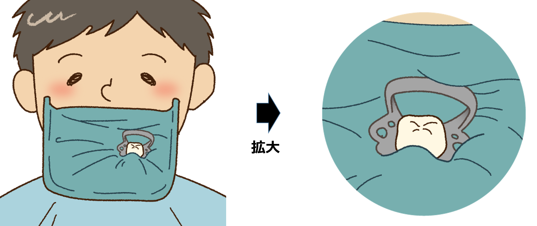 歯の神経の治療で使用するラバーダム